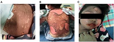 Successful Treatment of Carbamazepine-Induced Toxic Epidermal Necrolysis With Clinical Gastrointestinal Involvement: A Case Report